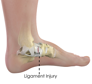 Ligament Pain/Injury/Treatment