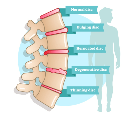 condition-disc-bulge