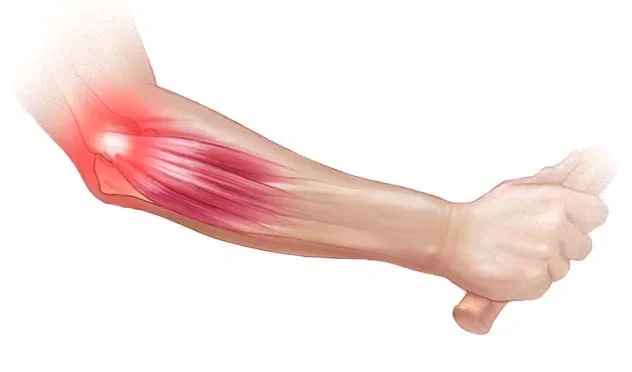 Tennis Elbow