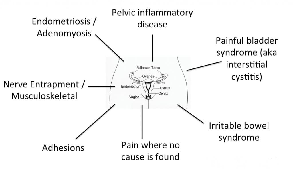 Common Causes of Chronic Pelvic Pain