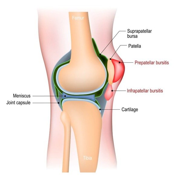 Bursitis