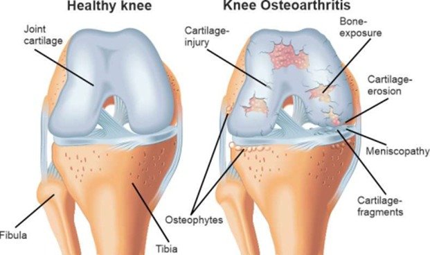 Osteoarthritis